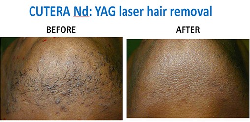 YAG-hair-removal