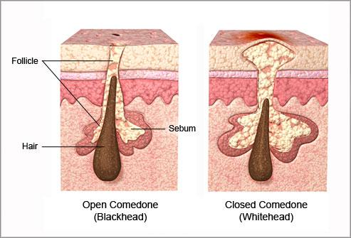 blocked-pores