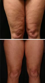 cellulite-treatments