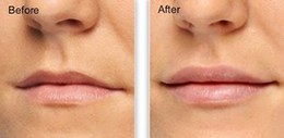 filler-lip-augmentation