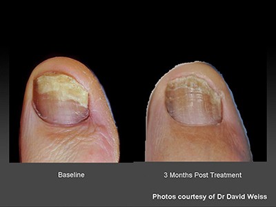 Aggressive 10 fingernail fungus CURED with NO Oral medication in just 2  months! Thrilled is an understatement. : r/NailFungus