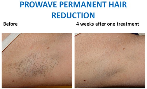 prowave-hair-removal