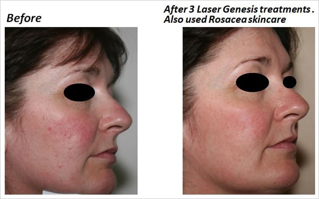 rosacea-cs-2