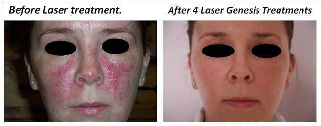 rosacea-cs-3