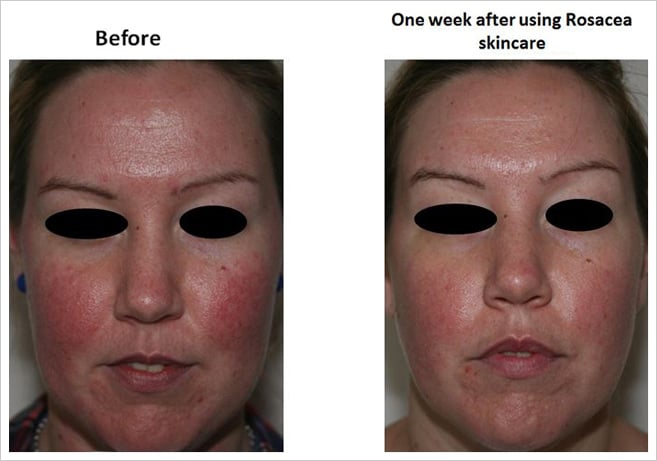 rosacea-cs-4