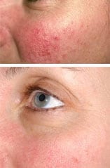 rosacea